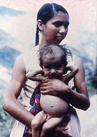 Se produce suficiente comida para alimentar bien a todos los niños. Sin embargo, la desnutrición es una de las causas más comunes de discapacidad. Para reducir la discapacidad, debemos asegurarnos de que todos los niños coman lo suficiente.