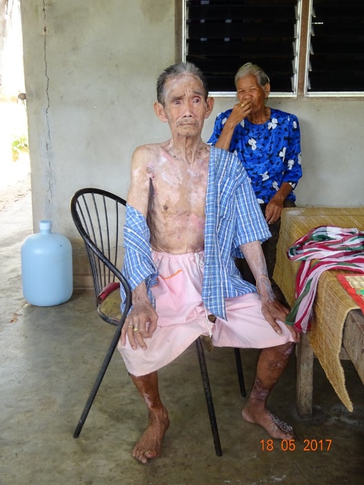 El hombre, que tuvo un ictus nueve años antes, estaba muy delgado y tenía úlceras crónicas en la piel. Vivía solo con su anciana esposa, que hacía todo lo posible por cuidarlo.