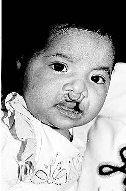 Sofia before cleft lip repair