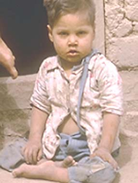 Marcelo, as a young boy with his legs paralyzed by polio, sitting in front of his family’s hut. The village program helped him to walk, go to school, and then become a health worker.