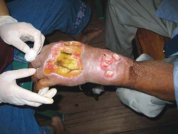 Severe diabetic ulcer on the hand of a villager