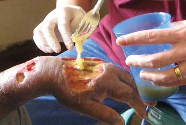 Kinari and Klara apply a paste of honey mixed with sugar to the ulcer.