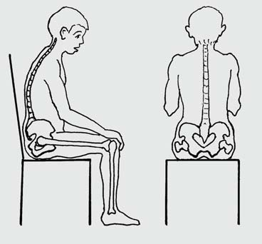 But for a child like Domingo who spends a lot of time sitting, the biggest risk of sores is over the butt bones (red arrows), on either side of buttocks.