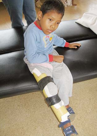 Domingo—who was born with spina bifida—is excited about the possibility of walk ing. This night brace to stretch his knee contractures, made of thin PVC pipe, is the first step.