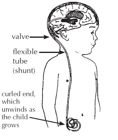 Shunt connecting the brain to the abdominal cavity.