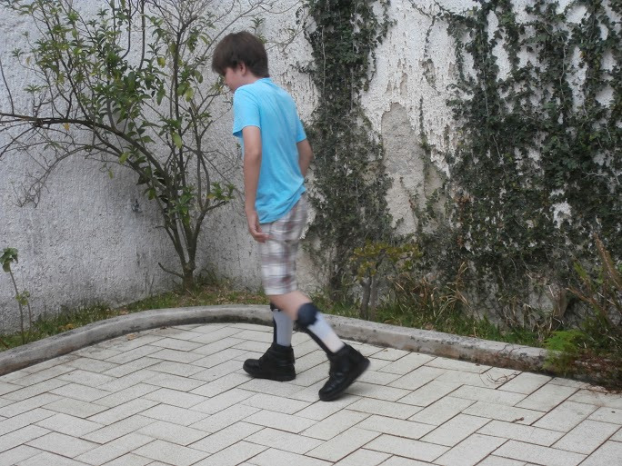 Tomás’s new braces are more comfortable than his old ones, and his walking is smoother and more stable.