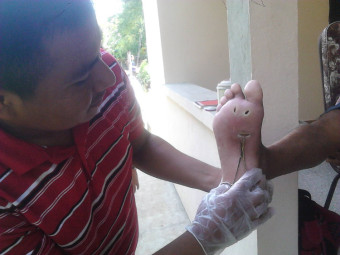 Werner Obeníel in his jungle village, treating a woman with diabetic ulcers. With the treatment and improved diet, she recovered.