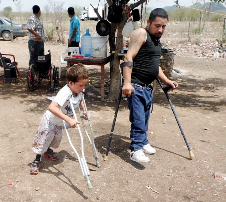 Teaching Miguél Ángel to walk with crutches, Tomás could demonstrate from his won experience.