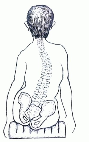 Spinal curve leads to a lopsided pelvis.