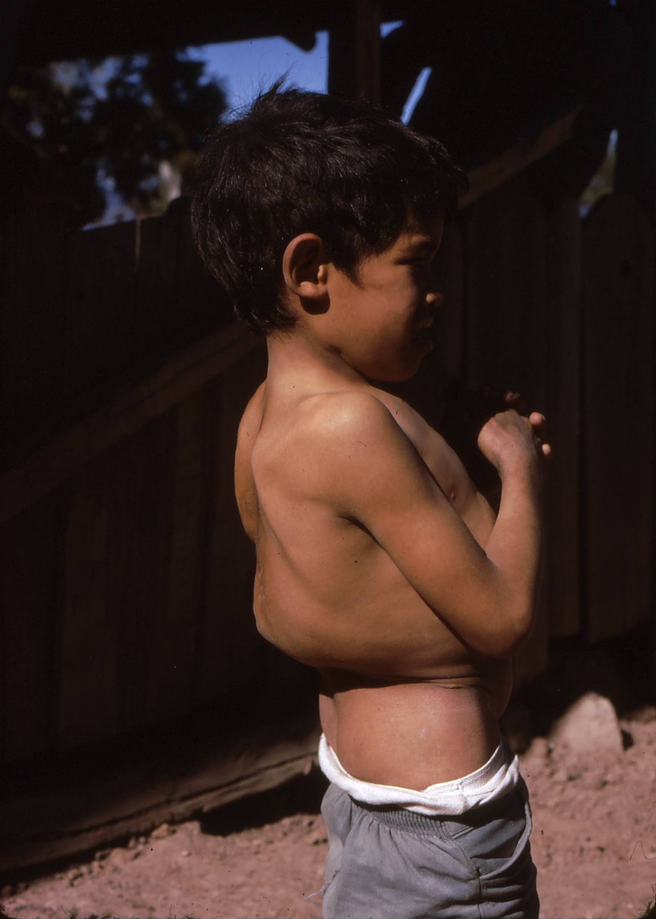 When Project Piaxtla began in the Sierra Madre, tuberculosis was ~~a~~ common, debilitating and often fatal affliction. This boy has Pott's disease, or TB of the spine. Thanks to the vaccination program TB became far less frequent.