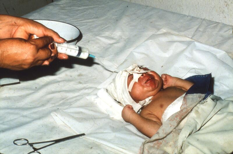 A baby with lockjaw from tetanus (who survived) is fed through a naso-gastric tube. Before pregnant women were vaccinated against tetanus, neonatal tetanus was one of the biggest killers of newborn babies.